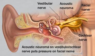 Da Hong Kong e Sydney per apprendere la tecnica endoscopica per rimuovere i neurinomi dell’acustico