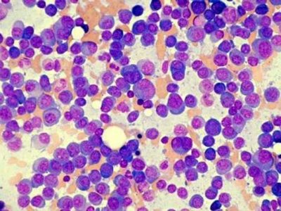 Mieloma multiplo: arriva in Italia carfilzomib.