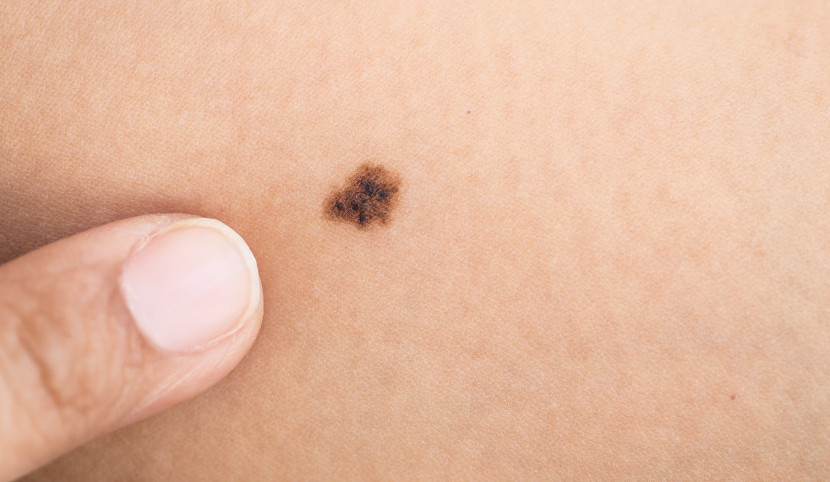 Tumori, melanoma in crescita: oltre 17mila casi attesi nel 2025