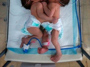 Sanità. Saranno divise in Veneto due gemelline siamesi della Sierra Leone. Zaia attiva il programma ricoveri umanitari della Regione. “Bravi medici tenteranno di dar loro un futuro”